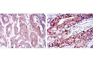 Immunohistochemical analysis of paraffin-embedded stomach cancer (left) and prostate cancer (right) using EIF4E mouse mAb with DAB staining.