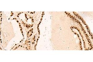 Immunohistochemistry of paraffin-embedded Human thyroid cancer tissue using SNRPB2 Polyclonal Antibody at dilution of 1:75(x200) (SNRPB2 anticorps)
