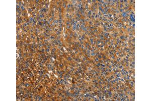 Immunohistochemistry of Human liver cancer using ORM2 Polyclonal Antibody at dilution of 1:40 (Orosomucoid 2 anticorps)