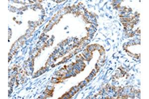 The image on the left is immunohistochemistry of paraffin-embedded Human esophagus cancer tissue using ABIN7192908(TRIM47 Antibody) at dilution 1/20, on the right is treated with synthetic peptide. (TRIM47 anticorps)