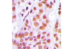 Immunohistochemical analysis of PRPF3 staining in human breast cancer formalin fixed paraffin embedded tissue section. (PRPF3 anticorps)