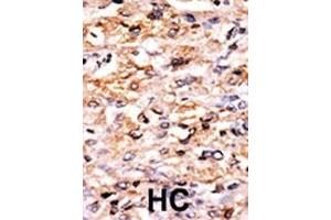 Formalin-fixed and paraffin-embedded human cancer tissue reacted with the primary antibody, which was peroxidase-conjugated to the secondary antibody, followed by AEC staining. (GCN2 anticorps  (N-Term))