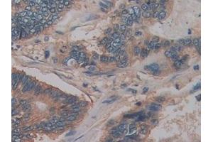 Detection of CD147 in Human Colorectal cancer Tissue using Polyclonal Antibody to Cluster Of Differentiation 147 (CD147)