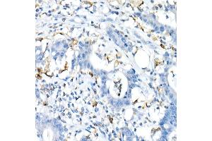 Immunohistochemistry of paraffin-embedded Human colon carcinoma using CD74 antibody (ABIN6128421, ABIN6138228, ABIN6138230 and ABIN6221316) at dilution of 1:25 (40x lens). (CD74 anticorps  (AA 73-232))