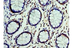 Immunohistochemistry of paraffin-embedded human colon cancer using ABIN7149003 at dilution of 1:100 (CST7 anticorps  (AA 20-145))