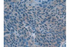 DAB staining on IHC-P; Samples: Human Esophagus cancer Tissue