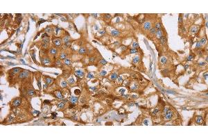 Immunohistochemistry of paraffin-embedded Human breast cancer using LTF Polyclonal Antibody at dilution of 1:40 (Lactoferrin anticorps)