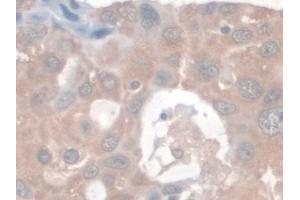 Detection of Nesp2 in Human Breast cancer Tissue using Polyclonal Antibody to Nesprin 2 (Nesp2)
