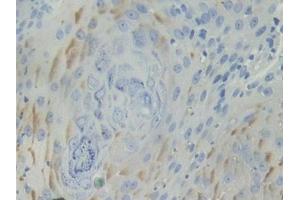 DAB staining on IHC-P; Samples: Human Skin cancer Tissue (BCAM anticorps  (AA 32-257))