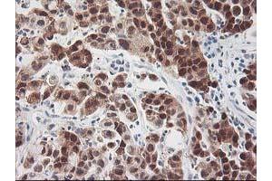 Immunohistochemical staining of paraffin-embedded Carcinoma of Human lung tissue using anti-HSPBP1 mouse monoclonal antibody. (HSPBP1 anticorps)