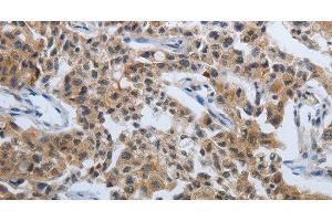 Immunohistochemistry of paraffin-embedded Human lung cancer tissue using PDCD7 Polyclonal Antibody at dilution 1:60 (PDCD7 anticorps)
