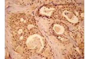 Immunohistochemistry analysis of human breast cancer tissue with MEK1 pAb. (MEK1 anticorps  (N-Term))