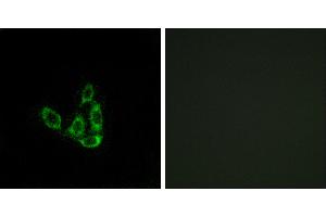 Peptide - +Immunohistochemistry analysis of paraffin-embedded human liver carcinoma tissue using GCNT3 antibody.