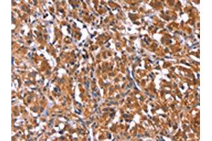 The image on the left is immunohistochemistry of paraffin-embedded Human thyroid cancer tissue using ABIN7192753(TDP2 Antibody) at dilution 1/40, on the right is treated with synthetic peptide. (TDP2 anticorps)