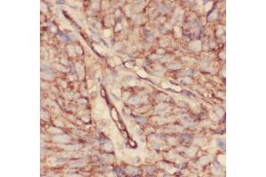 Anti-CD34 Picoband antibody,  IHC(P): Human Lung Cancer Tissue (CD34 anticorps  (AA 151-385))
