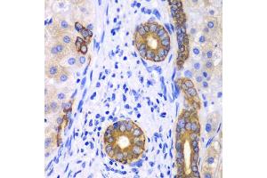 Immunohistochemistry of paraffin-embedded human liver cancer using KRT19 antibody (ABIN5970077) at dilution of 1/100 (40x lens). (Cytokeratin 19 anticorps)