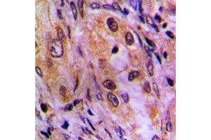Immunohistochemical analysis of AKR1C2 staining in human lung cancer formalin fixed paraffin embedded tissue section. (AKR1C2 anticorps)