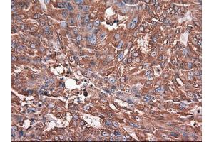 Immunohistochemical staining of paraffin-embedded Adenocarcinoma of breast using anti-CPA1 (ABIN2452647) mouse monoclonal antibody. (CPA1 anticorps  (AA 1-419))