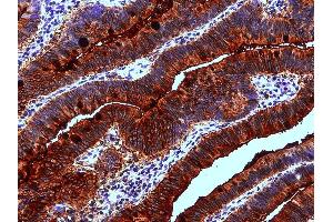 Immunohistochemistry staining of human colon adenocarcinoma (paraffin-embedded sections) with anti-Blood Group Lewis a (7LE). (Blood Group Lewis A anticorps)