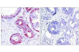 Immunohistochemical analysis of paraffin-embedded human breast carcinoma tissue using c-Jun(Phospho-Ser243) Antibody(left) or the same antibody preincubated with blocking peptide(right).
