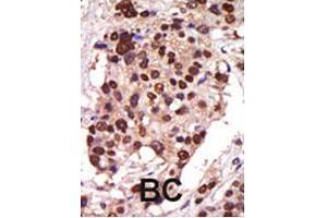 Formalin-fixed and paraffin-embedded human cancer tissue reacted with the PRKD3 polyclonal antibody  , which was peroxidase-conjugated to the secondary antibody, followed by AEC staining . (PRKD3 anticorps  (Internal Region))