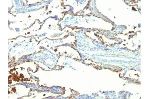 Formalin-fixed, paraffin-embedded human Lung Carcinoma stained with Milk Fat Globule Monoclonal Antibody (SPM291) (MFGE8 anticorps)