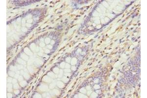 Immunohistochemistry of paraffin-embedded human colon cancer using ABIN7175357 at dilution of 1:100 (Vangl1 anticorps  (AA 275-524))
