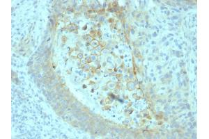Formalin-fixed, paraffin-embedded human Pancreatic Carcinoma stained with CD73 Mouse Monoclonal Antibody (NT5E/2545).