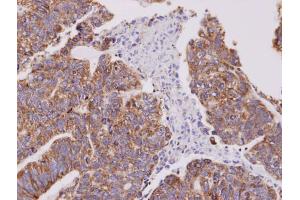 IHC-P Image Immunohistochemical analysis of paraffin-embedded human gastric cancer, using Cofilin 2, antibody at 1:100 dilution. (Cofilin 2 anticorps  (C-Term))