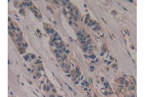 IHC-P analysis of Human Breast cancer Tissue, with DAB staining. (Poliovirus Receptor anticorps  (AA 56-309))