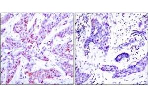 Immunohistochemistry analysis of paraffin-embedded human breast carcinoma, using ATF4 (Ab-245) Antibody. (ATF4 anticorps  (AA 212-261))
