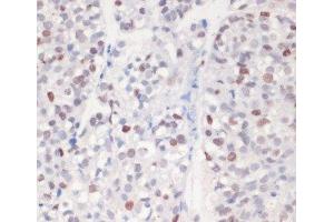 Immunohistochemistry of paraffin-embedded Human gastric cancer using Phospho-γH2A. (gamma H2AX anticorps  (pSer139))