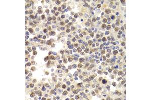 Immunohistochemistry of paraffin-embedded human B cell lymphoma using MCM4 Antibody (ABIN5971548) at dilution of 1/200 (40x lens). (MCM4 anticorps)