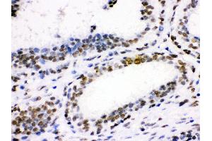 Anti- CDK1 Picoband antibody, IHC(P) IHC(P): Human Mammary Cancer Tissue (CDK1 anticorps  (AA 66-297))