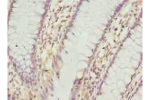 Immunohistochemistry of paraffin-embedded human colon cancer using ABIN7163544 at dilution of 1:100 (PLGRKT anticorps  (AA 1-147))