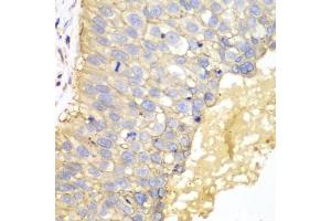Immunohistochemistry of paraffin-embedded human lung cancer using EPCAM antibody (ABIN5970523) at dilution of 1/100 (40x lens). (EpCAM anticorps)