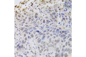 Immunohistochemistry of paraffin-embedded human esophageal cancer using HDGF Antibody. (HDGF anticorps  (AA 1-240))