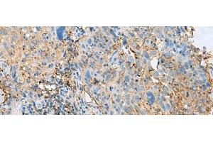 Immunohistochemistry of paraffin-embedded Human cervical cancer tissue using HLA-DPB1 Polyclonal Antibody at dilution of 1:50(x200) (HLA-DPB1 anticorps)