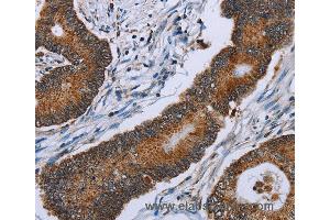 Immunohistochemistry of Human colon cancer using IDH2 Polyclonal Antibody at dilution of 1:60 (IDH2 anticorps)