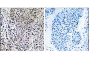 Immunohistochemistry analysis of paraffin-embedded human lung carcinoma tissue, using BRP16 Antibody. (FAM203B anticorps  (AA 251-300))