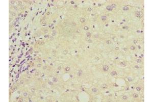 Immunohistochemistry of paraffin-embedded human liver cancer using ABIN7149150 at dilution of 1:100
