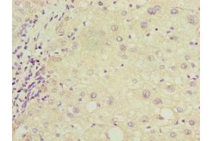 Immunohistochemistry of paraffin-embedded human liver cancer using ABIN7149150 at dilution of 1:100 (COX17 anticorps  (AA 1-63))