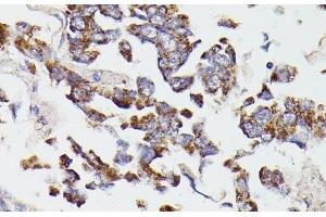 Immunohistochemistry of paraffin-embedded Human lung cancer using SUCLG2 Polyclonal Antibody at dilution of 1:100 (40x lens). (SUCLG2 anticorps)