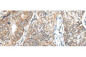 Immunohistochemistry of paraffin-embedded Human gastric cancer tissue using NADK2 Polyclonal Antibody at dilution of 1:40(x200) (NADK2 anticorps)