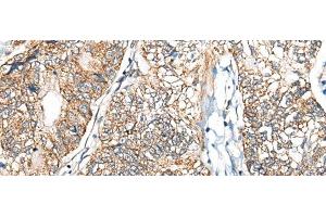 Immunohistochemistry of paraffin-embedded Human gastric cancer tissue using NADK2 Polyclonal Antibody at dilution of 1:40(x200)