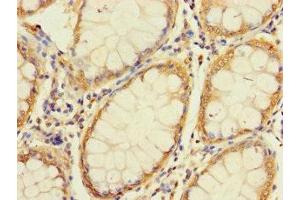 Immunohistochemistry of paraffin-embedded human colon cancer using ABIN7166269 at dilution of 1:100 (UNC93A anticorps  (AA 374-415))