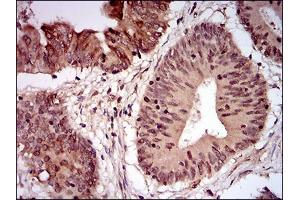 Immunohistochemical analysis of paraffin-embedded colon cancer tissues using NBN mouse mAb with DAB staining.