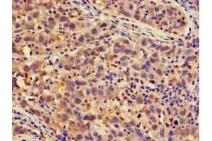 Immunohistochemistry of paraffin-embedded human pancreatic cancer using ABIN7164956 at dilution of 1:100 (PSMA4 anticorps  (AA 148-184))