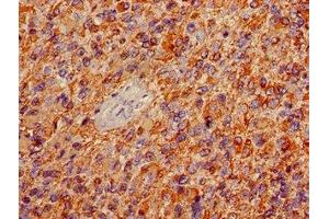 Immunohistochemistry of paraffin-embedded human glioma using ABIN7153847 at dilution of 1:100