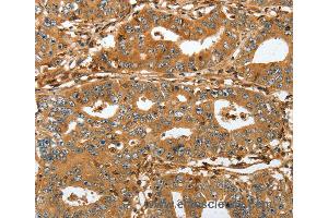 Immunohistochemistry of Human lung cancer using RAP1A Polyclonal Antibody at dilution of 1:45 (RAP1A anticorps)